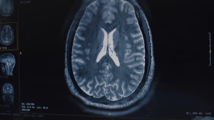 A detailed MRI scan animates through the cross-sections of a human brain on a medical monitor