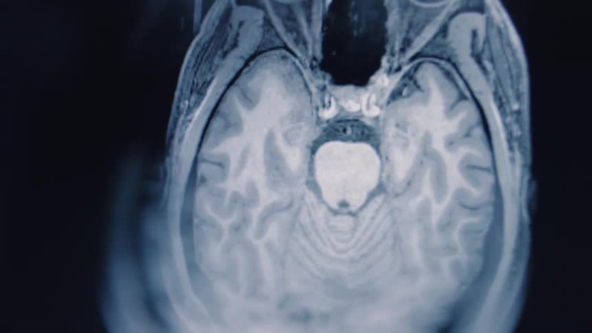 A detailed coronal view of an MRI brain scan moves through various layers, revealing the intricate anatomy of the human mind