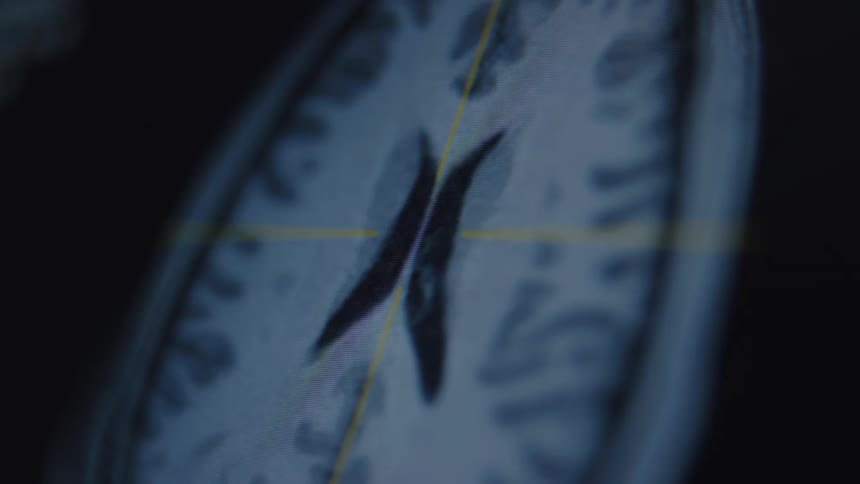 A close-up of a digital MRI scan on a monitor, revealing a cross-sectional view of the human brain for neurological analysis