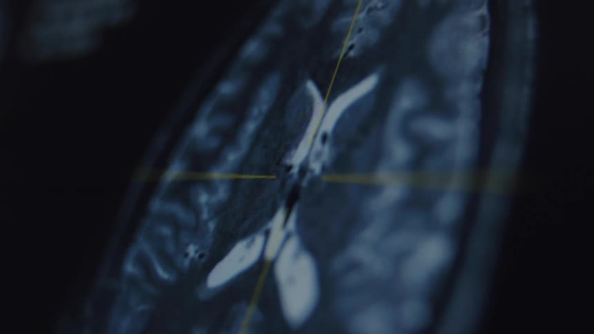 A close-up view of a human brain MRI scan being examined on a digital screen