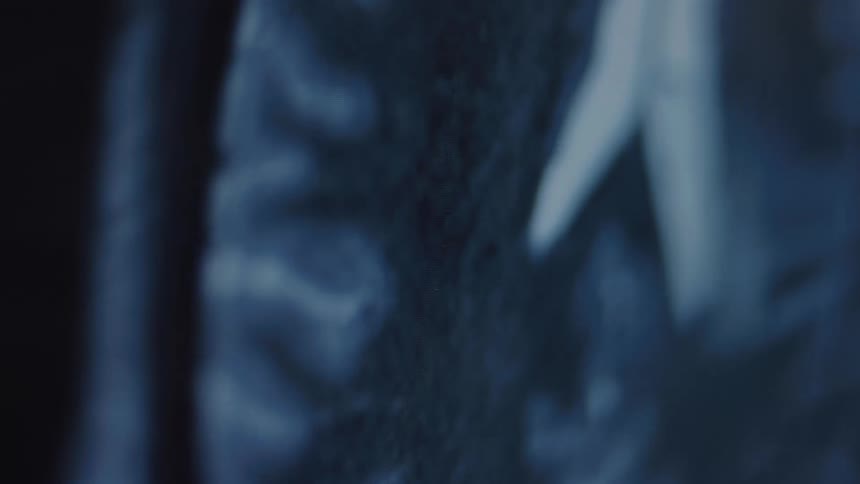 An out-of-focus close-up shot slowly pans across a medical MRI scan showing the interior of a human brain