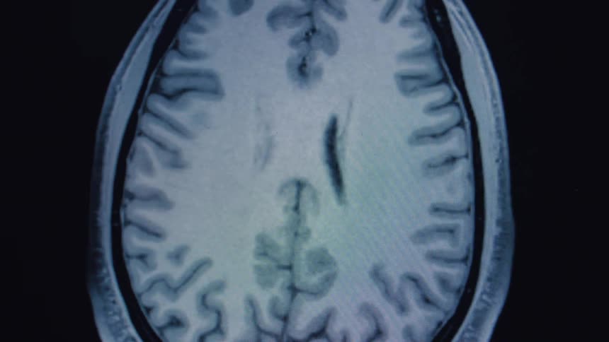 A detailed MRI animation reveals the intricate layers of a human brain in a top-down view