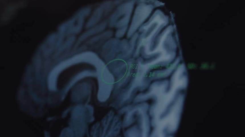 Close-up of a digital screen showing a medical MRI scan of a human brain with a region of interest analyzed