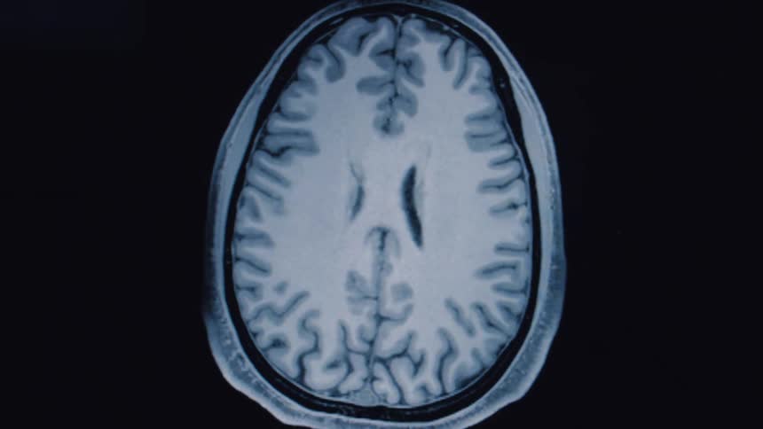 An animated sequence of an MRI scan revealing the detailed cross-sections of a human brain against a black background
