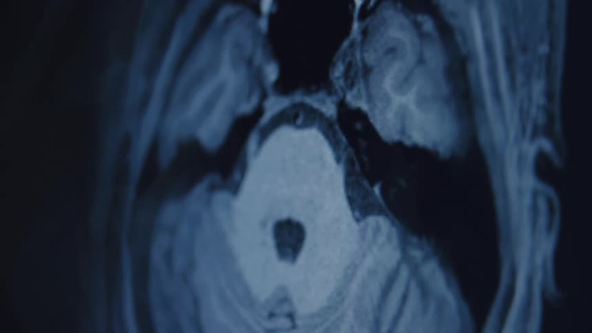 A close-up animated sequence of a human brain MRI scan showing the various layers and structures of the mind