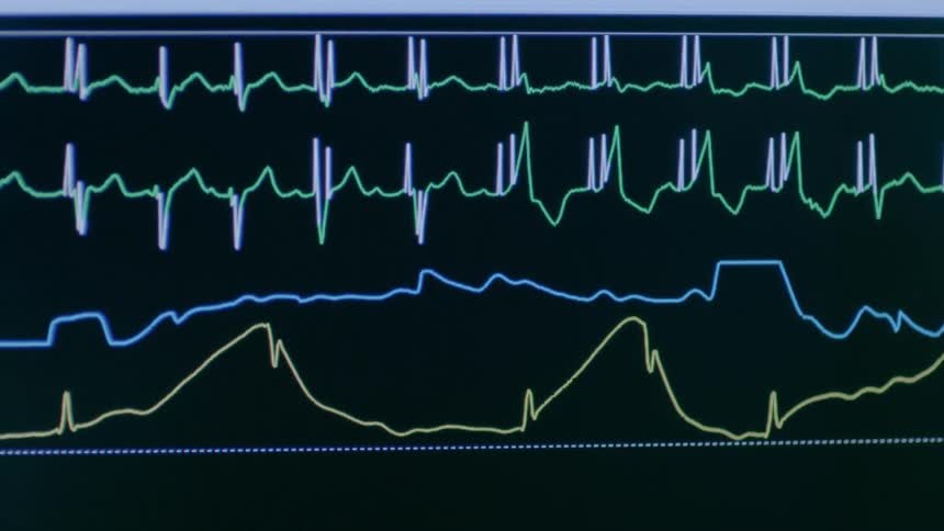 The monitor is showing gridded lines moving