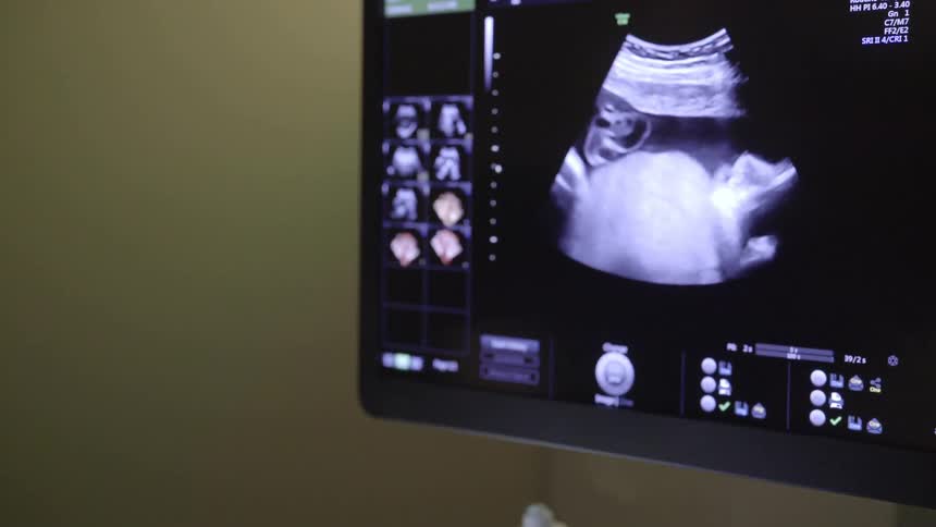 A fetus is shown on a monitor during an ultrasound