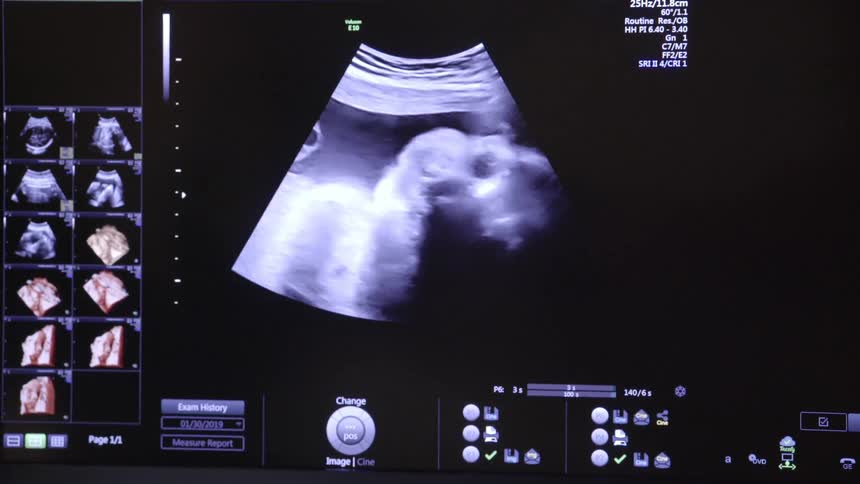 A picture of a screen with an ultrasound of a baby on