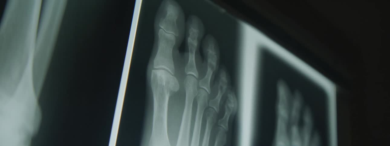 X ray of a bones are displayed