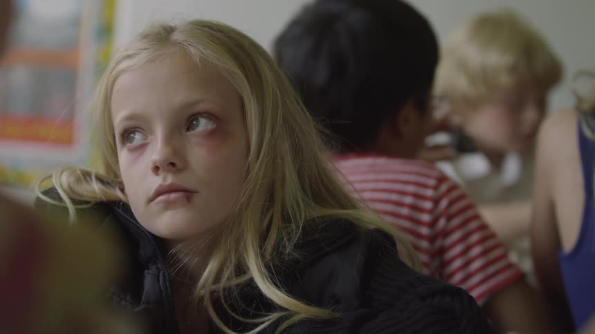 A pal little girl with a black eye in class